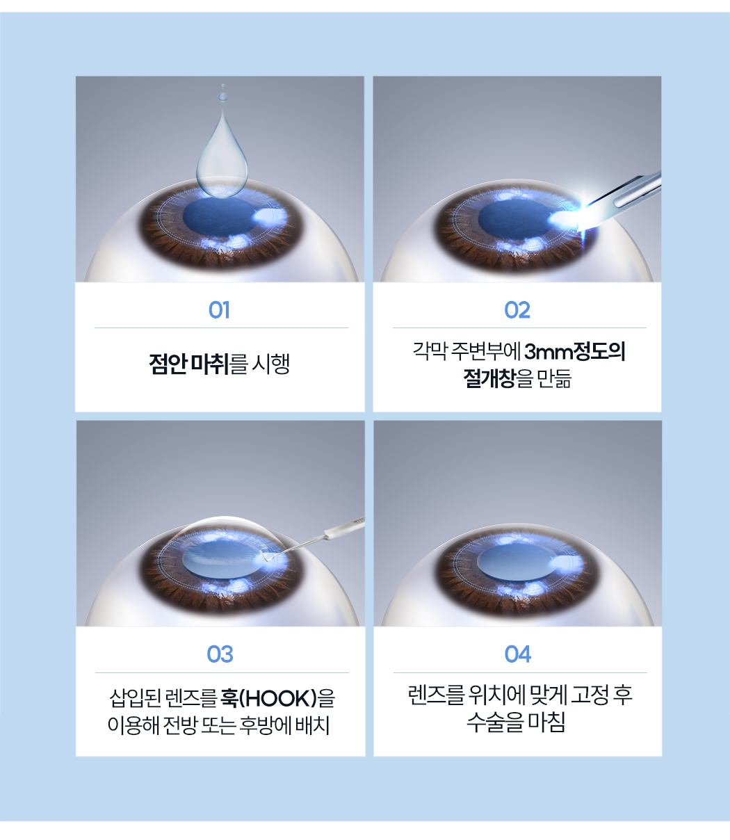 렌즈삽입술